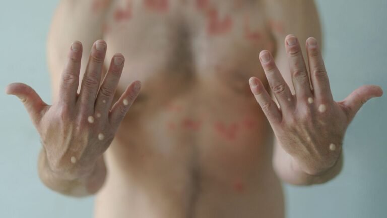 mpox1