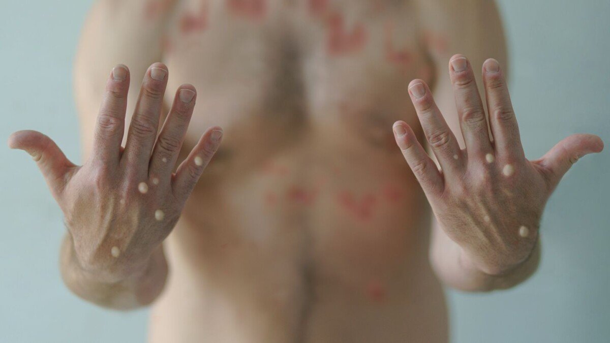mpox1
