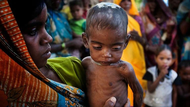 malnourishment_(1)